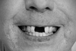 Quais as consequências da ausência de dentes?