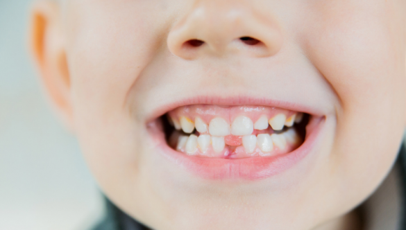 Afinal, quando os dentes de leite caem? Veja se existe uma época certa