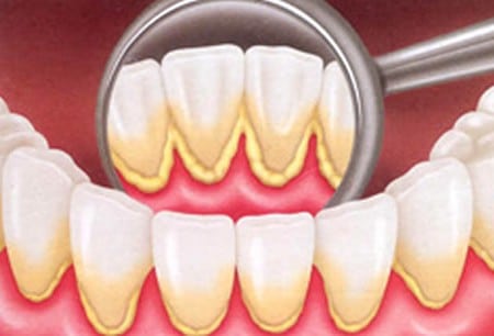 Tártaro nos dentes: o que causa e como evitar? - Villa Odontologia Avançada