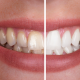 Clareamento dental vale a pena mesmo?